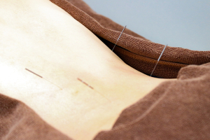 池袋鍼灸院の鍼灸施術の施術風景画像です。