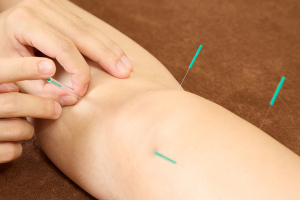 上板橋かまた鍼灸接骨院の鍼灸施術の施術風景画像です。