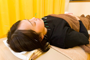 まつもと接骨院（龍ケ崎院本院）の美容鍼の施術風景画像