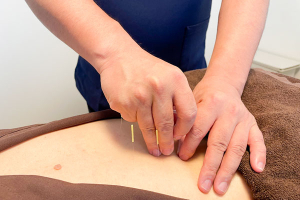 シャローム鍼灸院の腰痛の施術風景画像です。