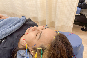 志村三丁目駅前鍼灸院・接骨院の美容鍼の施術風景画像