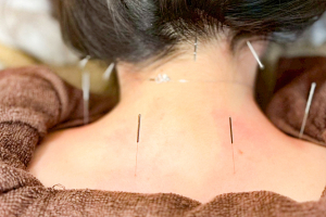 美容鍼灸サロンｇｒｅｅｎ京都　四条烏丸院の肩こりに対する施術風景画像