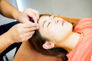 イーライフ鍼灸接骨院　豪徳寺院の鍼灸の施術風景画像