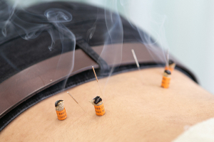 すずらん鍼灸・接骨院　小牧院の鍼灸施術の施術風景画像です。