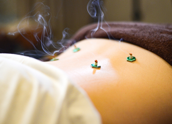 あかさか二丁目接骨院【鍼灸】(お灸で身体内部からキレイにしていきます。)