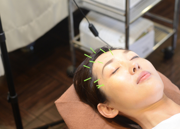 あかさか二丁目接骨院【鍼灸】(細い鍼のため、痛みはほぼございません。)