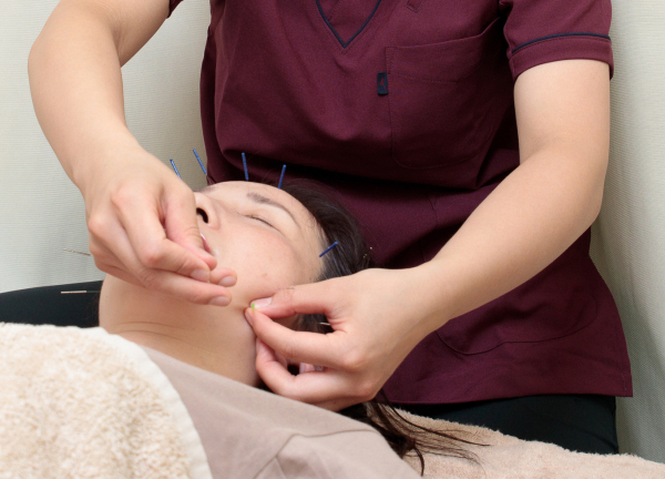 五健鍼灸整骨院　経堂本院(美容鍼でしわやたるみなどのお悩みにアプローチいたします。)