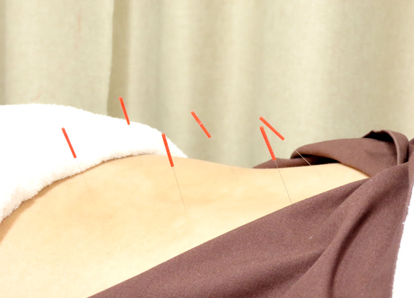 千歳烏山駅前鍼灸院・整骨院(手技では届きにくい深層にある筋肉を鍼で刺激します。)