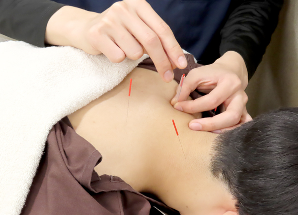 千歳烏山駅前鍼灸院・整骨院(局所的な痛みを鍼で緩和いたします。)
