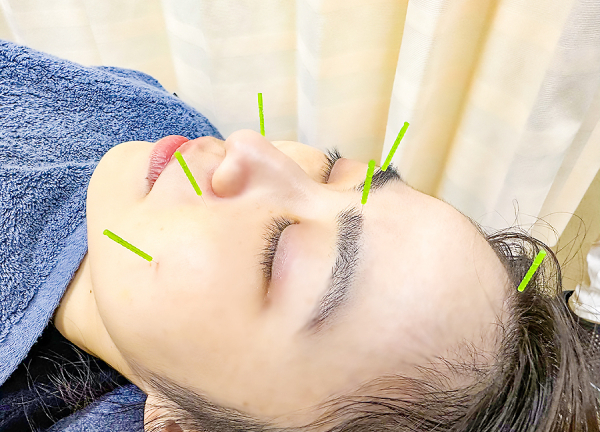 笹塚　せせらぎ整骨院【鍼灸】(お顔まわりのお悩みは美容鍼でアプローチします。)