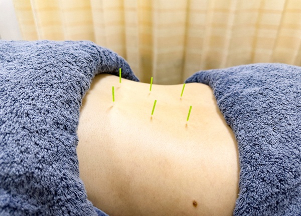 笹塚　せせらぎ整骨院【鍼灸】(鍼灸で自律神経の乱れを整えます。)