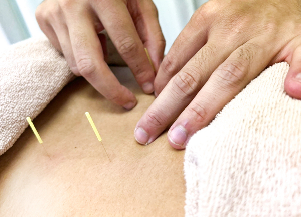こり固まった筋肉を鍼でアプローチします。