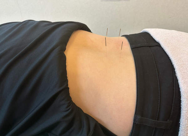 長者町ビオス整骨院【鍼灸】(鍼灸で筋肉の弛緩や血行促進、自律神経の調整をおこないます)