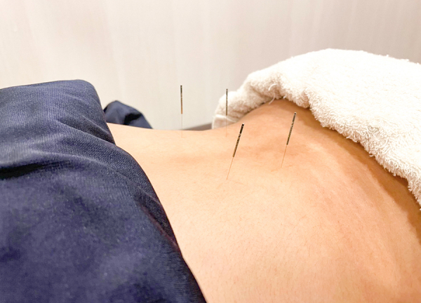 さくら鍼灸接骨院　大船院(鍼灸で筋肉の弛緩や血行促進、自律神経の調整をおこないます)