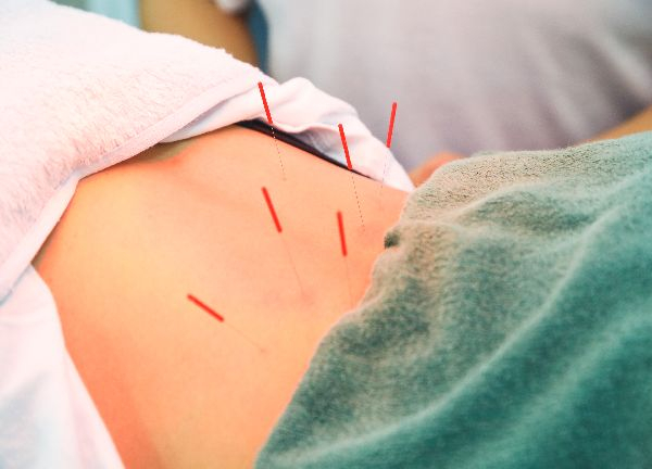 髪の毛ほどの細い鍼を使っております。