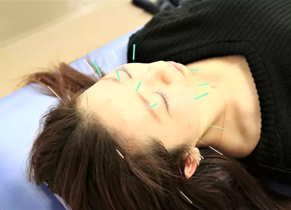 小林整骨院鍼灸院東海本院(肌荒れやシワ、気になるほうれい線のお悩みに美容鍼でご対応します。)