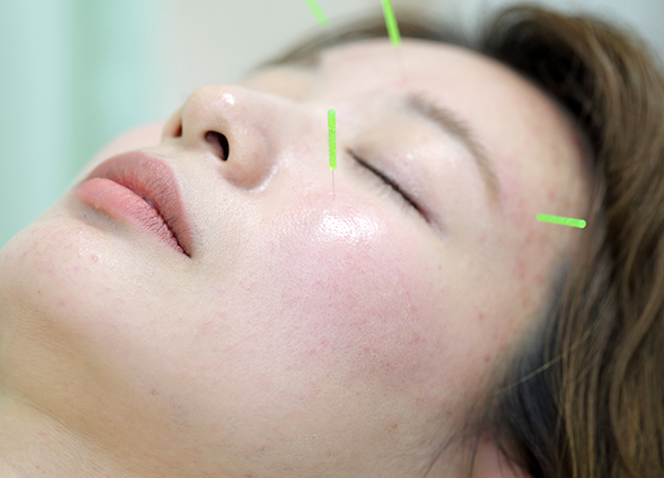 美容鍼もおすすめのメニューです
