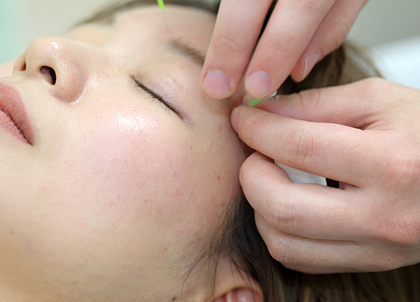 女性施術者による美容鍼の様子です