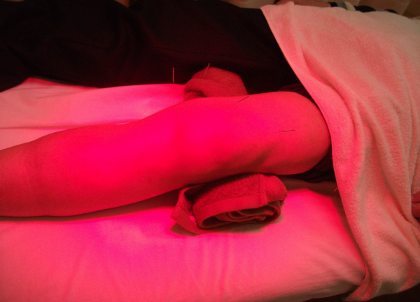 西岡鍼灸整骨院【マッサージ】(鍼灸施術の様子です。局所と全身は同じ料金となっています。)