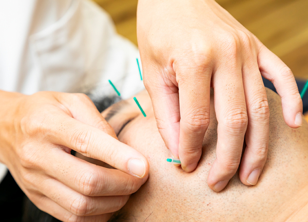 はばたき鍼灸整骨院(一本一本丁寧に刺していきます。)