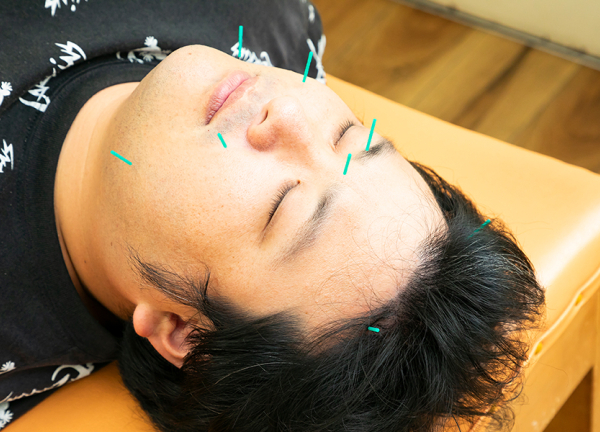 はばたき鍼灸整骨院(表情筋を緩めてスッキリしたお顔に。)