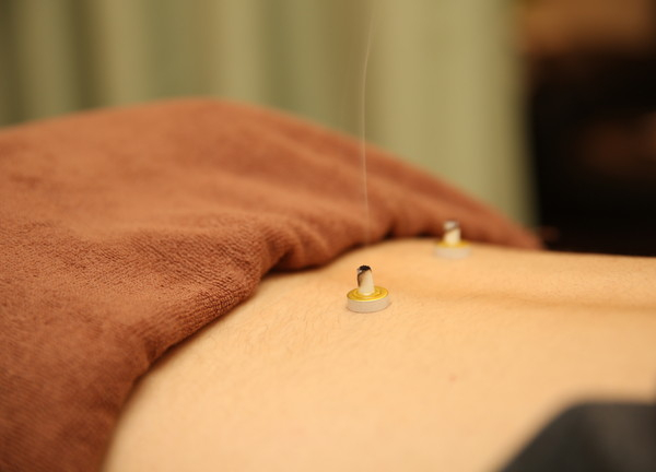 はりきゅうリラクゼーション治療院　治haru【鍼灸】(やけどの少ない間接灸を使用しています)