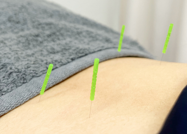 天王町そよかぜ鍼灸整骨院(鍼灸で筋肉の弛緩や血行促進、自律神経の調整をおこないます)