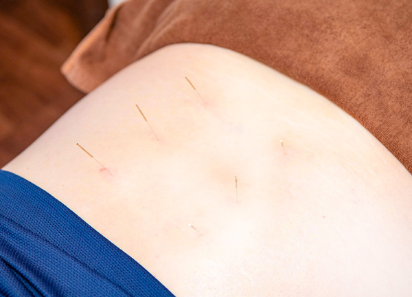 巣鴨総合治療院・整骨院　南加瀬院(細い鍼のため、痛みはほとんどございません。)