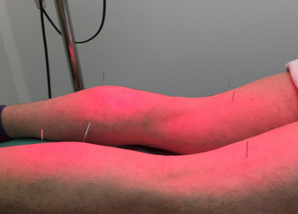 ケイはり灸治療院【鍼灸】(施術の様子)