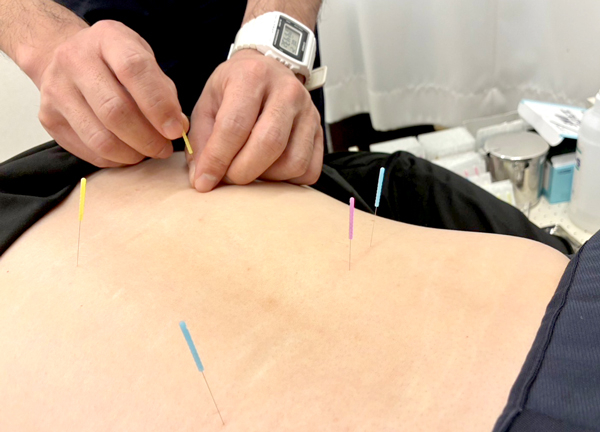ひだまり整骨院　沢ノ町院【鍼灸】(鍼灸にてお身体の深部までアプローチいたします。)