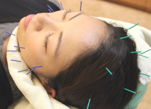 ＳＵＮ鍼灸整骨院(小顔美人コース（施術）)