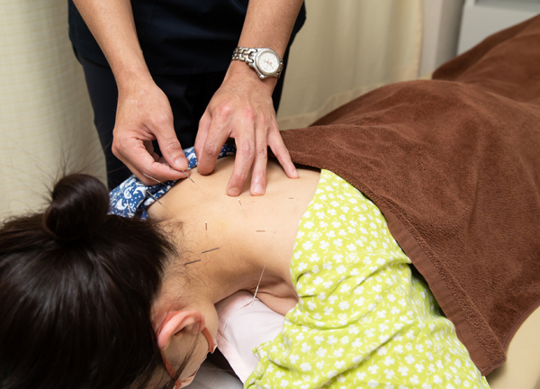 太陽鍼灸整骨院　池上院(硬くなった筋肉へ鍼を刺していきます。)