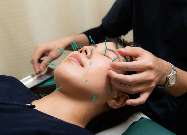 太陽鍼灸整骨院　池上院(美容鍼でお顔のむくみやたるみの改善を目指します。)