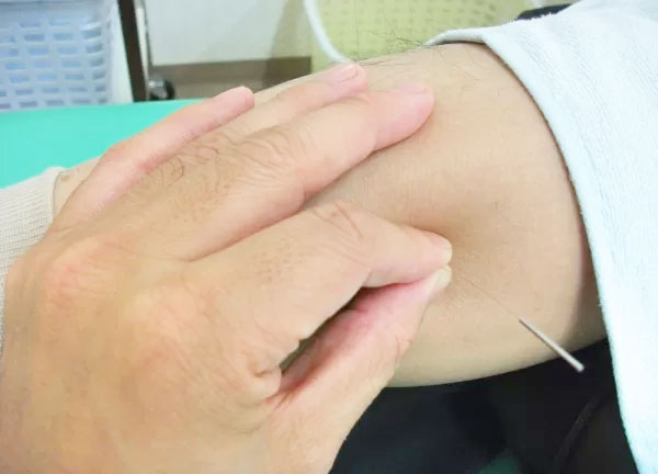 あおぞら鍼灸接骨院(はり施術中)