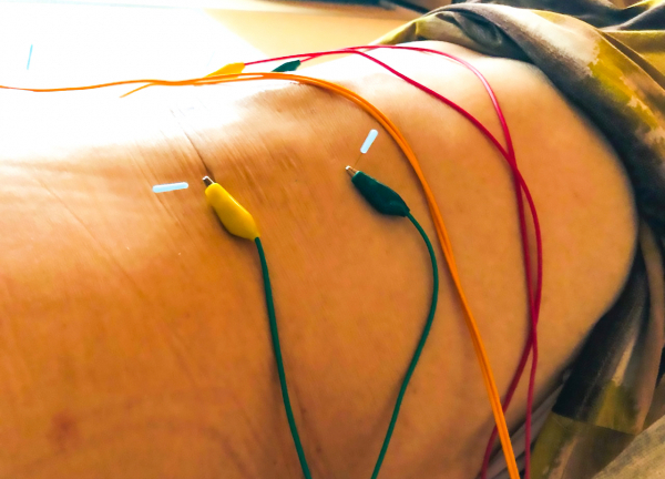 訪問鍼灸院らーく(パルスで深部の筋肉を緩めます。)