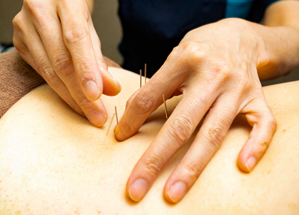 さくら鍼灸整骨院　上野院(一本一本丁寧に刺していきます)