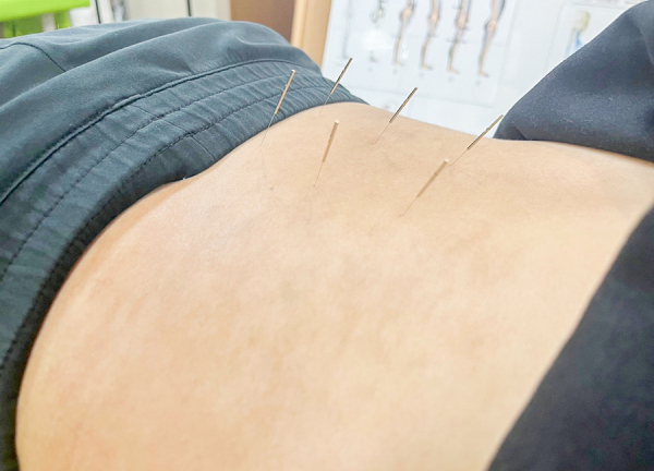 甲斐整骨院　薬院【鍼灸】(鍼灸の力で本来持っている力を引き出します。)