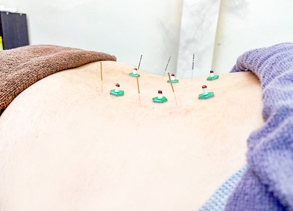 甲斐整骨院　薬院【鍼灸】(お灸でツボを刺激します。)