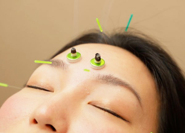 蘇摩鍼灸治療院竹内弘宜(鍼とお灸を同時に行うことができます。)