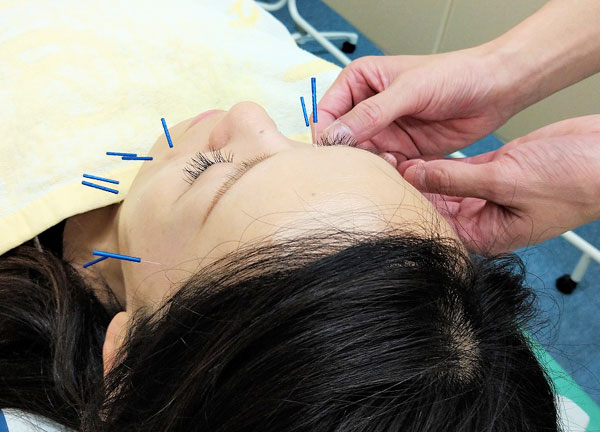 エース治療院【鍼灸】(気になるしわやたるみといったお悩みにも対応しています。)