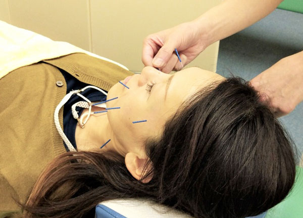 ハッピーライフ治療院【鍼灸】(美容鍼をおこなうことでむくみの緩和やリフトアップ効果が期待できます。)