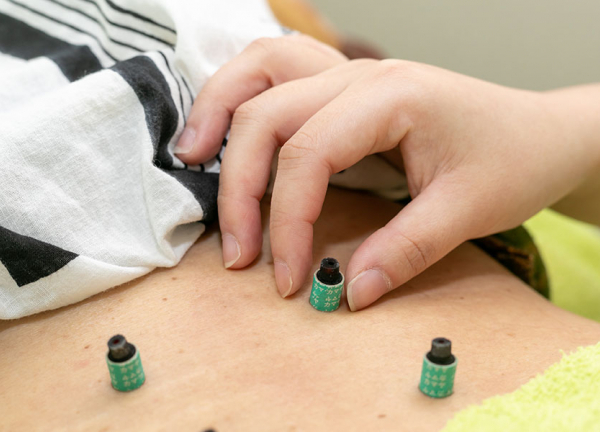 ハッピーライフ治療院【鍼灸】(灸の施術の様子です)