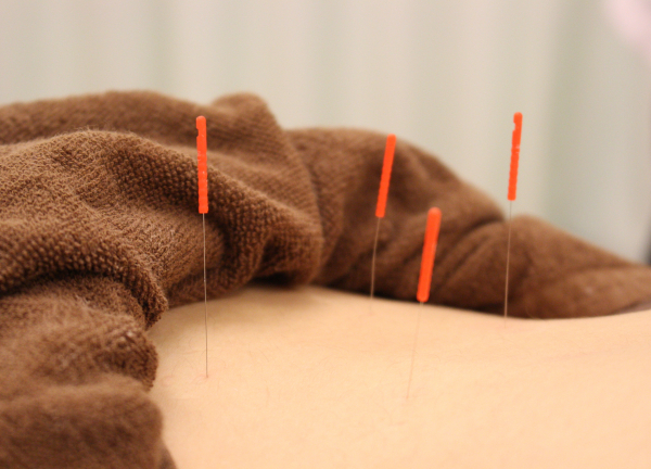 木賀鍼灸整骨院(つらい局所的な疲労や痛みは鍼でアプローチ！)