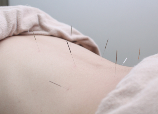 からだらか鍼灸整骨院　洗足池院(細い鍼で施術するのでほとんど痛みはございません★)