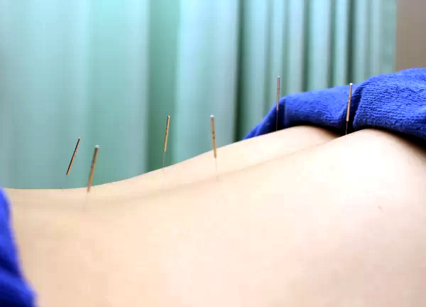 Ｆ．Ｃ．Ｃ．よみうりランド鍼灸整骨院（アメリア稲城様2階）(細い鍼で施術するのでほとんど痛みはございません★)