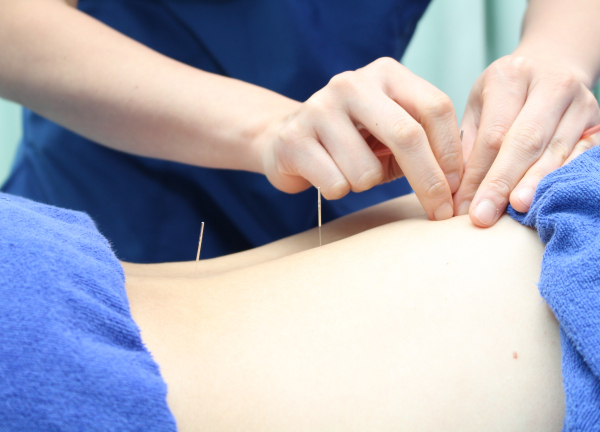 Ｆ．Ｃ．Ｃ．よみうりランド鍼灸整骨院（アメリア稲城様2階）(一本一本丁寧に鍼を刺していきます◎)