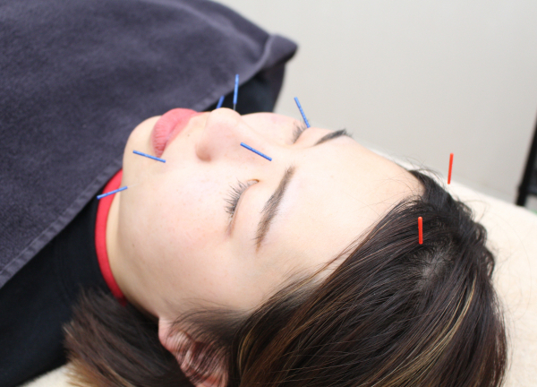 豪徳寺の鍼灸整骨院(肌荒れの対応にも効果が期待できます♪)