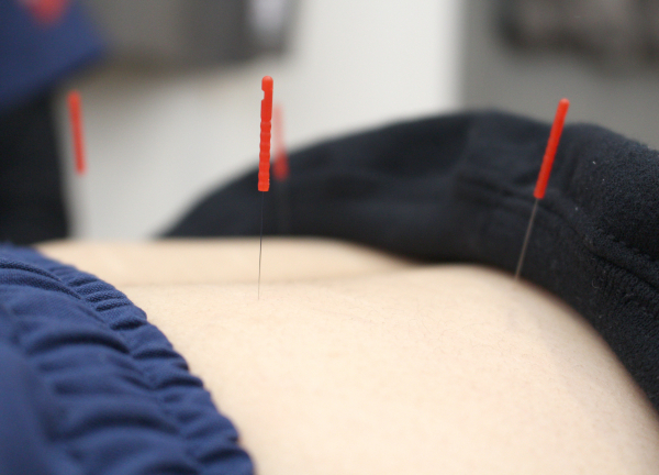 方南町駅前はり灸整骨院(細い鍼なので、痛みはほとんどございません！)