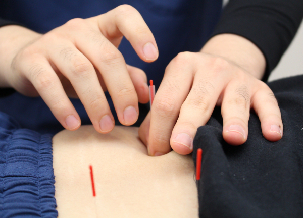 読売ランド前駅のはり灸整骨院(一本一本丁寧に刺していきます★)