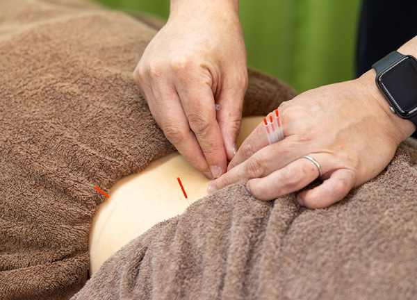 発寒南あおば鍼灸整骨院(鍼を使って血行促進や自律神経調整をおこないます。)
